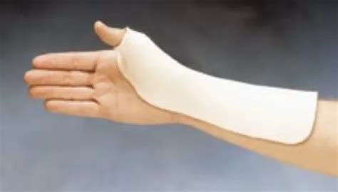 Radial Based Thumb Spica Splint