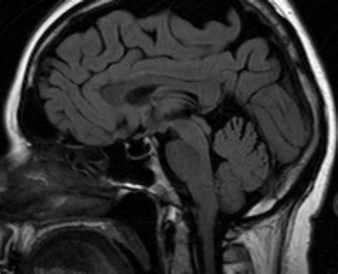 MedicoNotebook: Empty sella syndrome