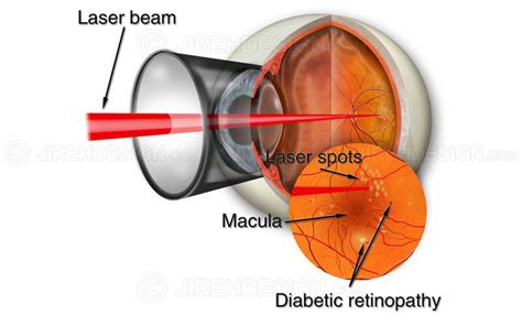 Retinal laser for diabetic retinopathy - #SUVR0033 | Stock eye images