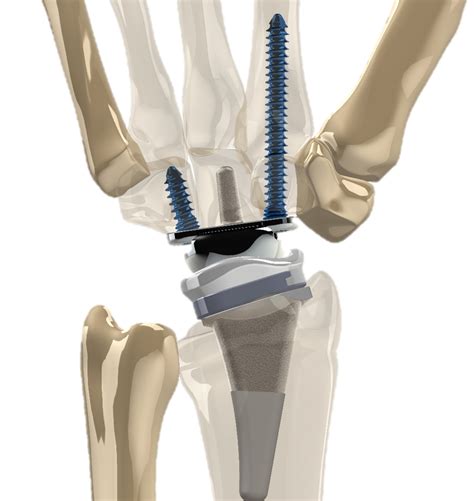 FDA Approves New Total Wrist Replacement Device