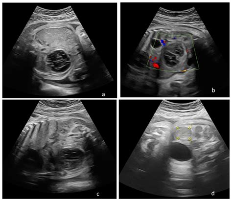 Dermoid Ovarian Cyst Ultrasound