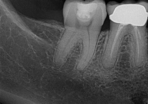 Root Canal Retreatment- Jensen Endodontics Inc