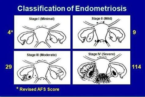 Endometriosis: Symptoms, treatment, and pain management