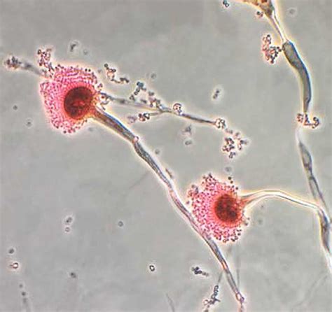 Aspergillus & Aspergillosis - Symptoms, Diagnosis, Treatment