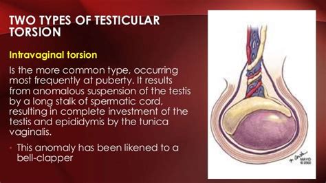 Testicular Torsion