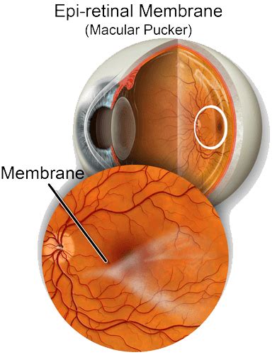 Epiretinal Membrane (Macular Pucker) Treatment & Surgery