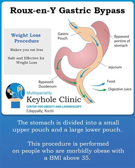 Roux-en-Y Gastric Bypass - Weight Loss Treatment in Kochi, Kerala