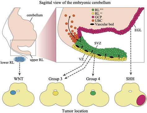 Cell of origin for each subgroup of medulloblastoma. The upper figure... | Download Scientific ...