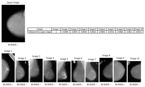 Bi Rads Classification