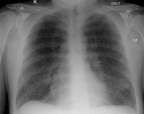 Langerhans cell histiocytosis chest x ray - wikidoc