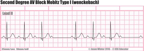 ECG Educator Blog : Heart Blocks