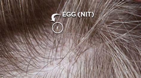 What are Nits & What do They Look Like | The Lice Removal Clinic