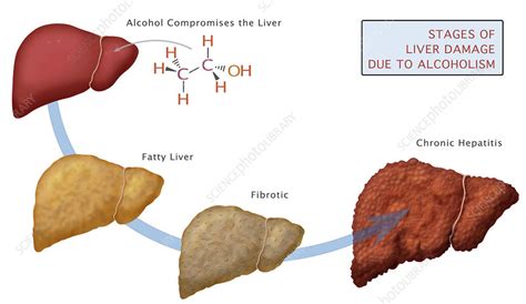 Stages of Liver Damage, Illustration - Stock Image - C027/6475 - Science Photo Library