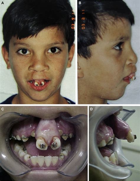 Preoperative photographs showing A, projection of the premaxilla ...