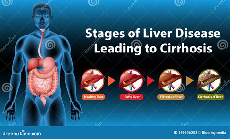 Stages of Liver Disease Leading To Cirrhosis Stock Vector - Illustration of sciences, scientific ...