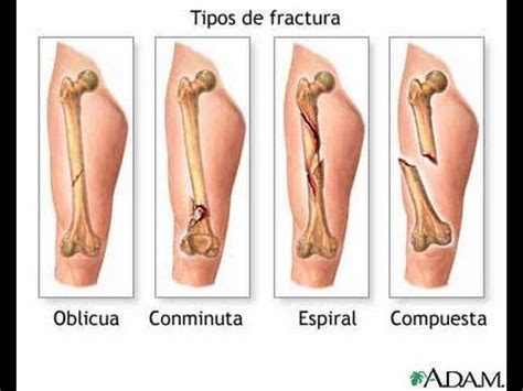 Rehabilitacion Fractura de femur - YouTube