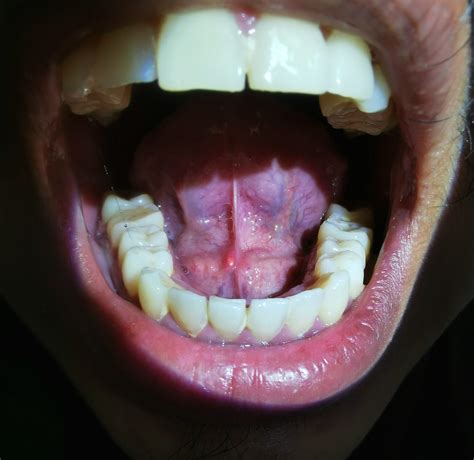 Sialolith: Can a Stone form in my salivary ducts? - Dr. Ruth - Otolaryngology