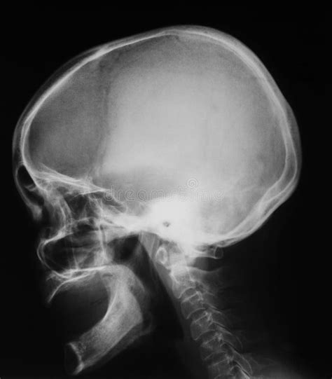 X-ray Image of Skull, Lateral View. Stock Image - Image of radiation, nasal: 53838797