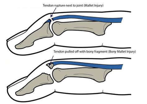 Mallet Injuries – Aberdeen Virtual Hand Clinic