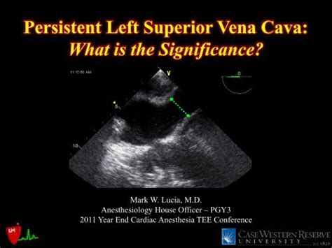 Persistent Left Superior Vena Cava: What is the ... - Casecag.com