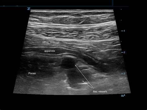 How to Diagnose Appendicitis in a Child | EM Ultrasound Section