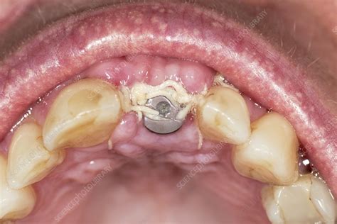 Temporary tooth implant - Stock Image - C023/4360 - Science Photo Library