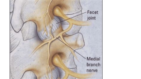 Medial Branch Blocks | Tarpon Interventional Pain & Spine Care