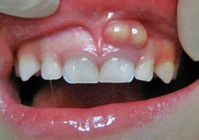 Tooth Abscess: How to Identify, Treat, and Prevent - Fresno Dentist ...