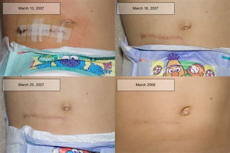 Abdominal Surgery: Types Of Incisions In Abdominal Surgery