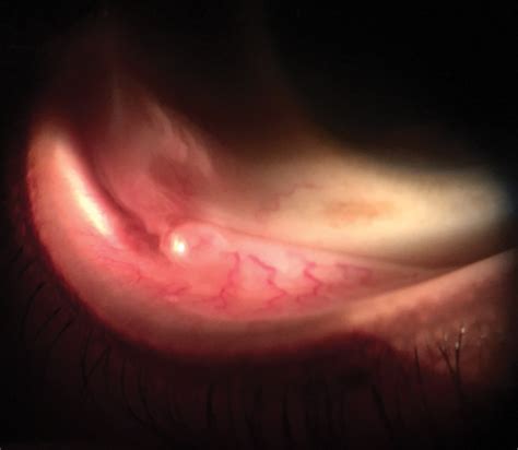 Eyelid Inclusion Cyst