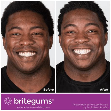 Can I Remove Purple Spots on My Gums? | Stanley Dentistry