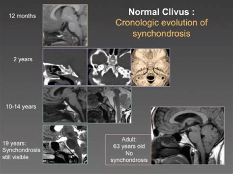 The Clivus Lesions: Crossroads Of Skull Base | Semantic Scholar