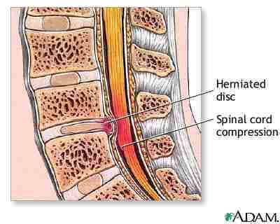 Slipped, Herniated Disc Symptoms, Treatment & Causes