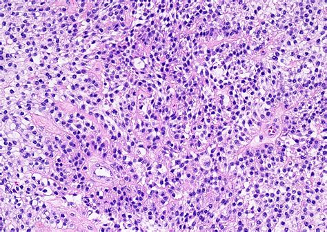 Mucoepidermoid Carcinoma Parotid Pathology Outlines - Fititnoora