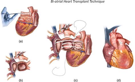 Evolution of Heart Transplantation Surgical Techniques | IntechOpen