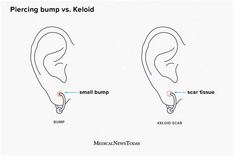 Piercing bump vs. keloid: How to tell the difference and what to do Nose Piercing Bump, Upper ...