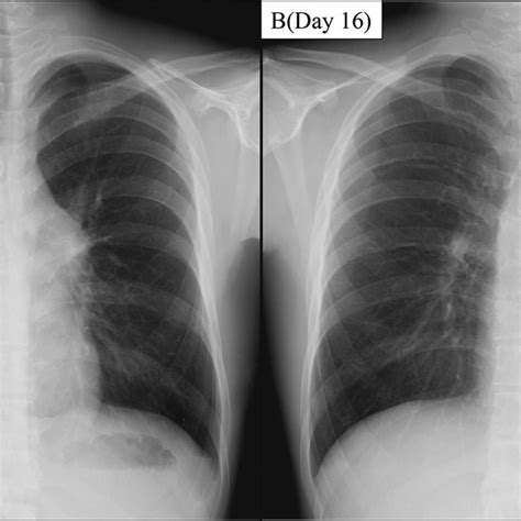 Chest X-ray before and after treatment. (A) Chest X-ray on the first... | Download Scientific ...