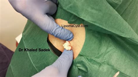 Back Cyst Removal Dr Khaled Sadek Lipomacyst – Otosection