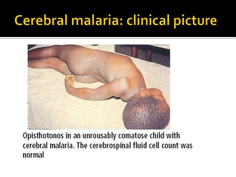 PPT - CEREBRAL MALARIA PowerPoint Presentation, free download - ID:2163636