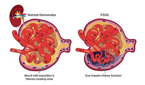 Focal Segmental Glomerulosclerosis (FSGS) - NephCure