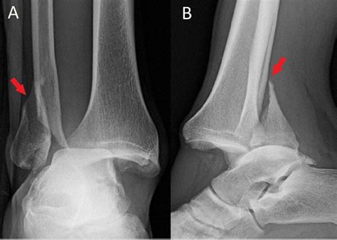 A Novel Technique for a Successful Closed Reduction of a Bosworth Fracture-Dislocation of the ...