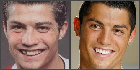 Cristiano Ronaldo - tanden voor en na een selectie van foto's