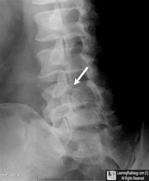 Learning Radiology - Spondylolysis