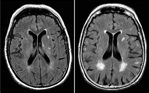 5-Minute Brain MRI Can Reveal Risk for Alzheimer's Disease