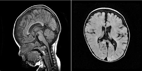 A brain MRI (at 11 months of age) shows diffuse atrophy in both ...