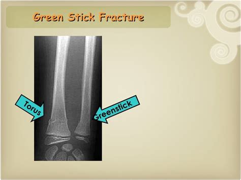 Paediatric fracture