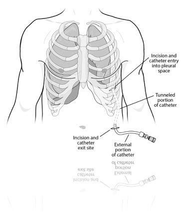 Placement and Care of your Aspira Drainage Catheter (Interventional Radiology) | Health and ...