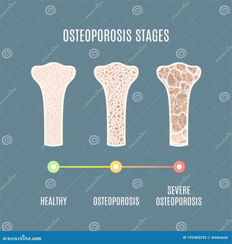 Bone Density DEXA Scan. Osteoporosis Diagnosis. Stock Photography | CartoonDealer.com #112414100