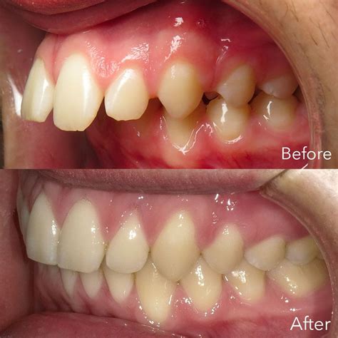 How To Fix an Overbite Using a Carriere Distalizer and Invisalign