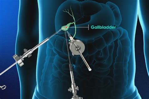 Gallbladder Removal Surgery in Pune- Kaizen Gastro Care